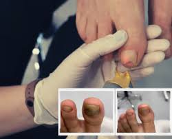 laser treatment of nail fungus doç dr