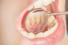 dental tartar calculus causes