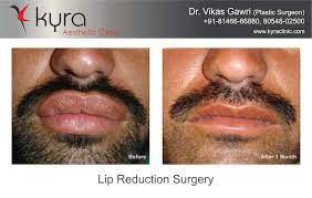 lip reduction surgery in gurdaspur