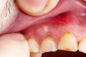 gum boils symptoms causes home