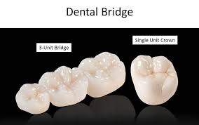 porcelain bridge westwood family dental