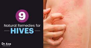 hives treatment 9 natural remes for