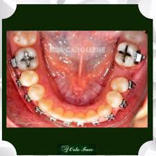 Primeiro de tudo, você precisará examinar a cavidade oral da garota e determinar quais dentes estão com dor. Tornese Consciente Departamento Escolha Aparelho Em Dentes Encavalados Celibidache Center Com