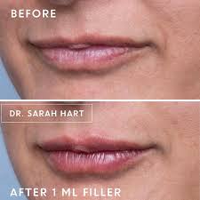 before and after photos by dr sarah hart