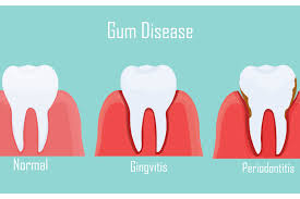 natural treatment for gum diseases