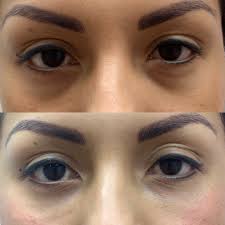eye filler real patient photos and