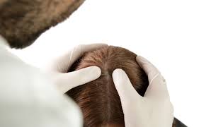 ringworm of the scalp symptoms causes