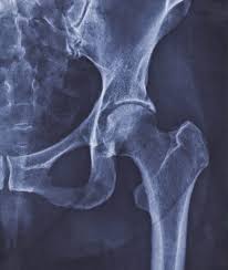 common types of hip surgeries joint