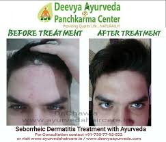 seborrheic dermais treatment with