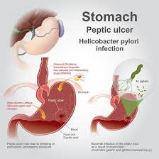gut when it comes to stomach ulcers
