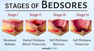 bedsores ses how to heal them is