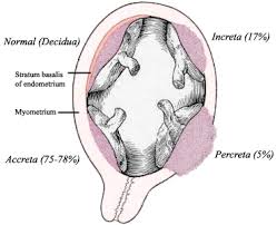 These types of placenta previa are classified according to the degree of the opening that is covered by the placenta. Placenta Accreta Spectrum Wikipedia