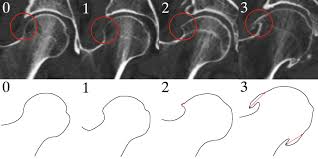 severity mapping of the proximal femur