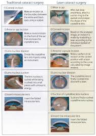 cataract surgery eye clinic tokyo en
