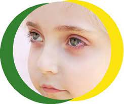 conjunctivitis nhs nottingham and