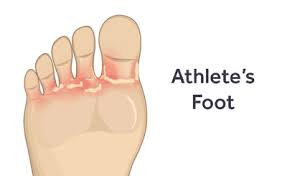 foot vs shoe contact dermais