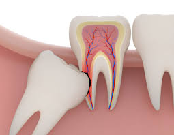 what to know about your wisdom teeth