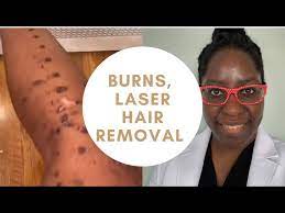 burns laser hair removal laser hair