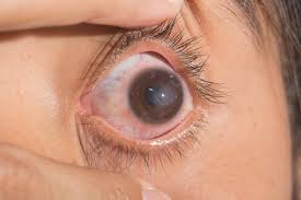 what is a corneal ulcer corneal
