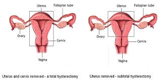 isted inal hysterectomy