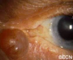 benign eyelid tumors hydrocystoma