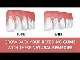5 effective home remes for gum