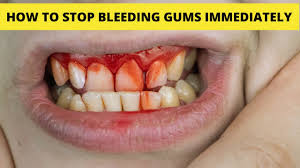 how to stop gum bleeding imately
