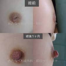 陥没乳頭（保険適用） | 【原則女性専用】静岡駅｜わたなべ形成外科・肌のクリニック