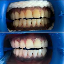 teeth whitening in cali colombia
