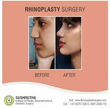 rhinoplasty thrissur nose surgery