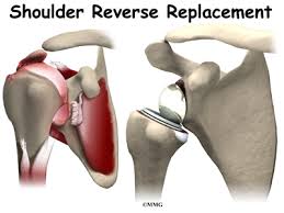 reverse shoulder arthroplasty james