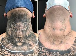 laser tattoo removal vancouver bc