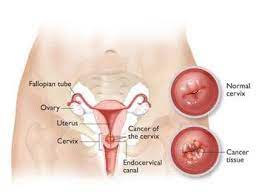 what is pap smear or pap test age