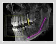 cone beam ct scan nyc dental implants