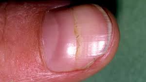 ridges in fingernails symptoms causes