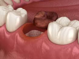 After a wisdom tooth removal, you might find that your teeth hurt after you drink. What Does Dry Socket Look Like Pics Info Treatment