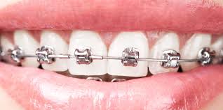Check out our video about the types of removable retainers and how. How To Clean Braces