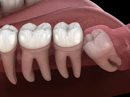wisdom teeth removal hamilton family