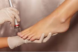 nail fungus with laser treatment