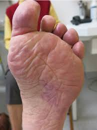 Palmar erythema may occur in about 30 to 60 percent of pregnant people. Palmar Erythema With Slight Edema Toes Are Involved As Well Download Scientific Diagram