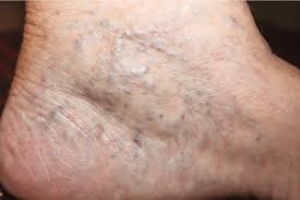 spider veins causes and treatment