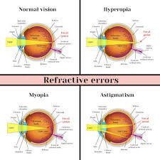 refractive error summit eye surgeons