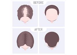 hair loss causes treatments