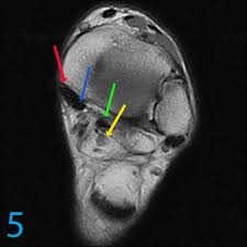 Mri with hardware in foot? Accessory Muscles In The Medial Ankle Proscan Imaging
