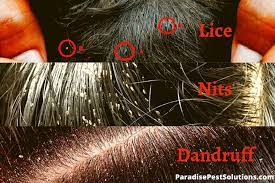 lice vs dandruff how to tell the