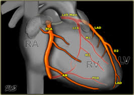 Termination of left anterior descending. The Radiology Assistant Coronary Anatomy And Anomalies