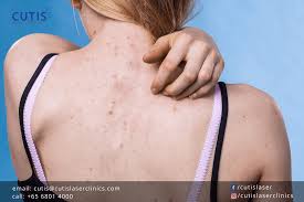 what can help with bacne and acne scarring