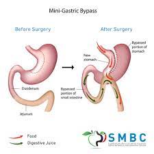 weight loss surgery types smbc