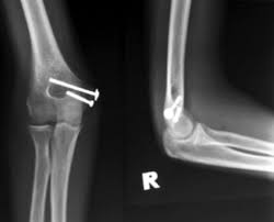 However, abnormal changes in the flexor carpi ulnaris and palmaris longus origins at the elbow may also be present. Radiographs Showing United Medial Humerus Epicondyle Avulsion Fracture Download Scientific Diagram