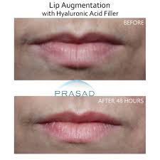 lip filler for uneven lips and smile
